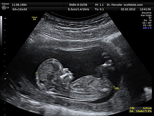 Ultrasound taken of a baby to show the development of a 12 week baby.